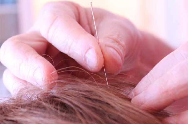 Acouphène Acupuncture