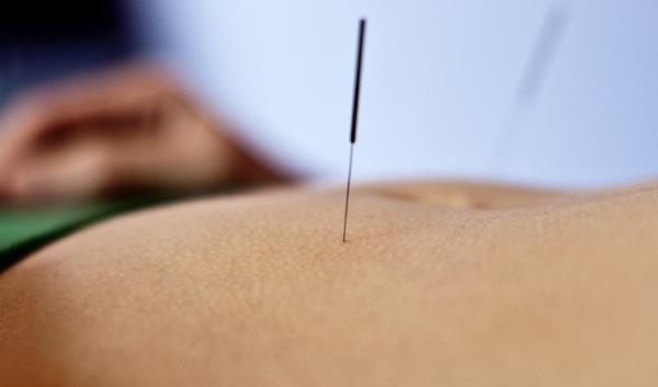 Acupuncture et acouphène