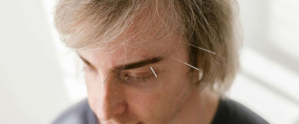 Acupuncture pour les acouphenes